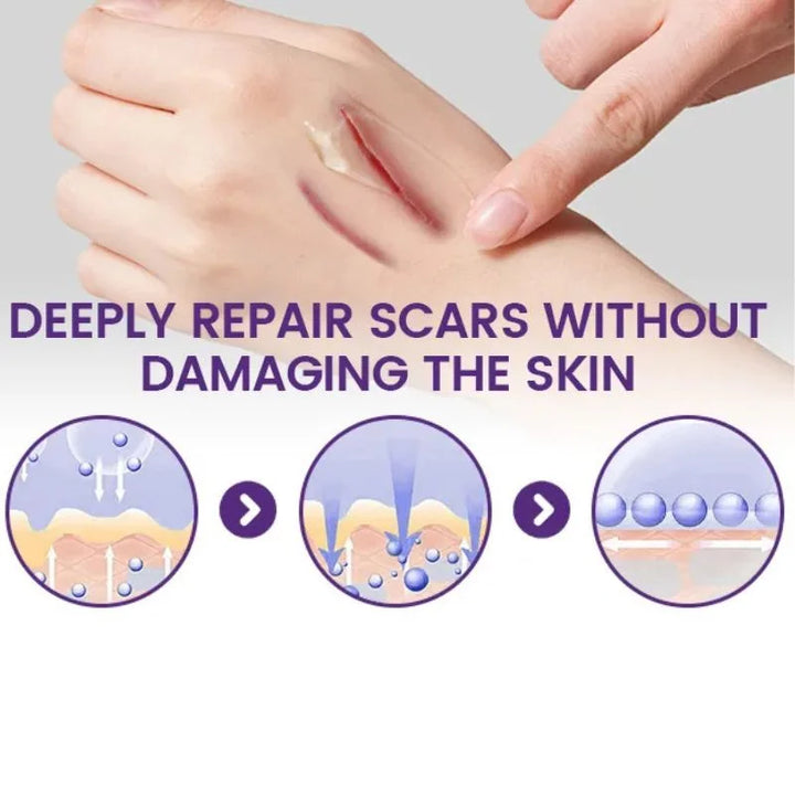 TIMILK Scar Removal Gel for Face & Body - Stretch Marks & Old Scars Repair Cream, Smooth Skin Treatment, 30g
