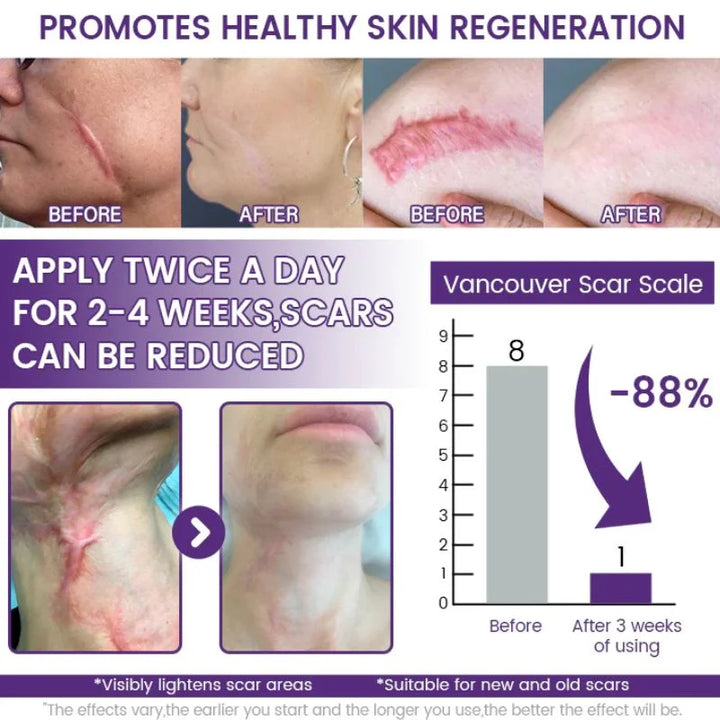 TIMILK Scar Removal Gel for Face & Body - Stretch Marks & Old Scars Repair Cream, Smooth Skin Treatment, 30g